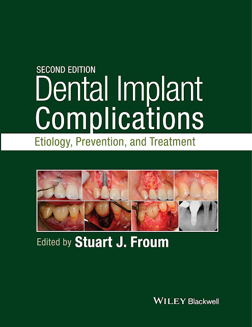 Dental Implant Complications 2nd Edition PDF Free Download (Direct Link)