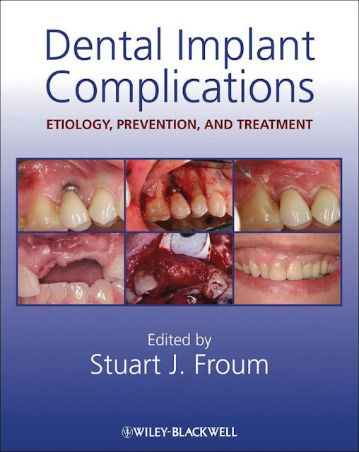 Dental Implant Complications PDF Free Download (Direct Link)