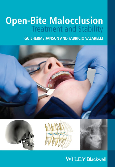 Open-Bite Malocclusion Treatment and Stability PDF Free Download (Direct Link)
