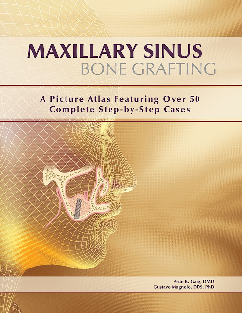 Maxillary Sinus Bone Grafting PDF Free Download (Direct Link)