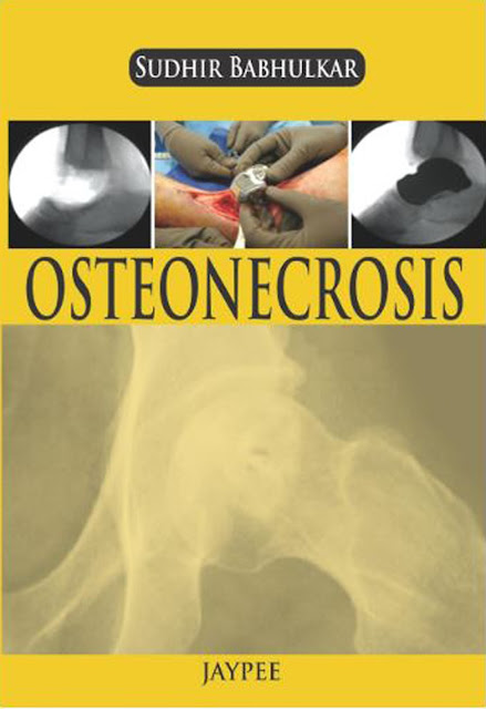 Osteonecrosis by Sudhir Babhulkar PDF Free Download (Direct Link)